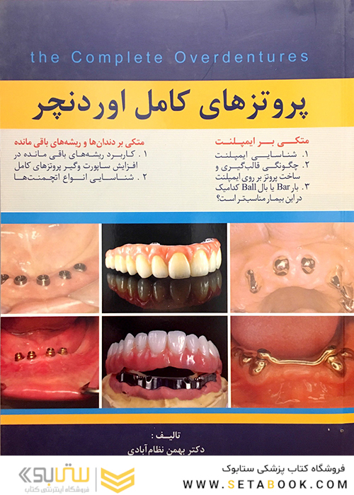 پروتزهای کامل اوردنچر