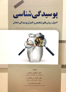 عکس پوسیدگی شناسی  اصول،روش های تشخیص و کنترل پوسیدگی دندان
