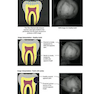 Principles and Biomechanics of Aligner Treatment