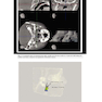 Principles and Biomechanics of Aligner Treatment