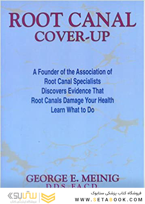 Root Canal Cover Up