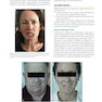 Management of Post-Facial Paralysis Synkinesis