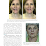 Management of Post-Facial Paralysis Synkinesis