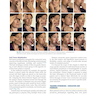 Management of Post-Facial Paralysis Synkinesis