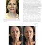 Management of Post-Facial Paralysis Synkinesis