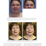 Management of Post-Facial Paralysis Synkinesis