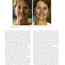 Management of Post-Facial Paralysis Synkinesis