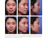 Aesthetic Plastic Surgery of the East Asian Face