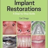 Implant Restorations : A Step-by-Step Guide