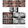 Temporary Anchorage Devices in Orthodontics 2nd Edition 2021