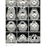 Target Volume Delineation and Field Setup : A Practical Guide for Conformal and Intensity-Modulated Radiation Therapy
