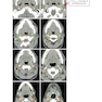 Target Volume Delineation and Field Setup : A Practical Guide for Conformal and Intensity-Modulated Radiation Therapy