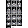 Target Volume Delineation and Field Setup : A Practical Guide for Conformal and Intensity-Modulated Radiation Therapy