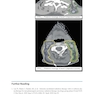 Target Volume Delineation and Field Setup : A Practical Guide for Conformal and Intensity-Modulated Radiation Therapy