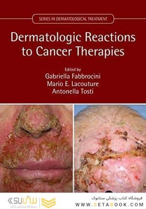 Dermatologic Reactions to Cancer Therapies2019واکنشهای پوستی به درمانهای سرطان