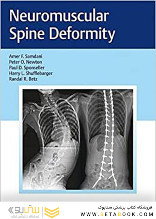 Neuromuscular Spine Deformity 1st Edition2018 تغییر شکل عضله عصبی عضلانی