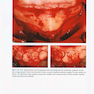 Vertical and Horizontal Ridge Augmentation