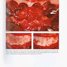 Vertical and Horizontal Ridge Augmentation