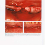 Vertical and Horizontal Ridge Augmentation