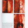 Vertical and Horizontal Ridge Augmentation