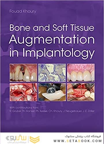 Bone and Soft Tissue Augmentation in Implantology 2022
