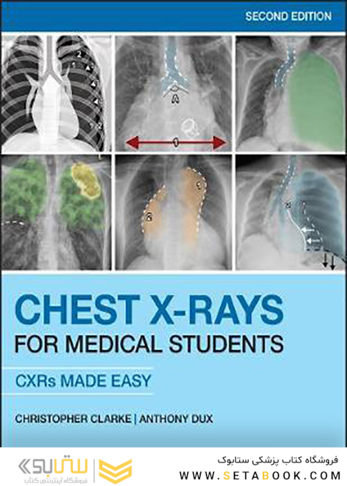 Chest X-Rays for Medical Students: CXRs Made Easy 2nd Edition2020