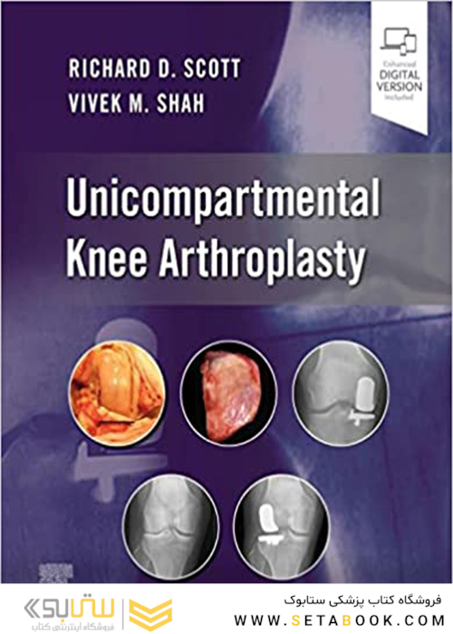 Unicompartmental Knee Arthroplasty