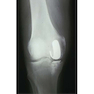 Unicompartmental Knee Arthroplasty