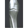 Unicompartmental Knee Arthroplasty