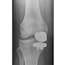 Unicompartmental Knee Arthroplasty