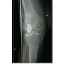 Unicompartmental Knee Arthroplasty