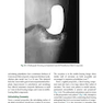 Unicompartmental Knee Arthroplasty