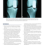 Unicompartmental Knee Arthroplasty