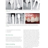 Zero Bone Loss Concepts 1st Edition 2019