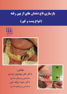 عکس بازسازی تاج دندان های از بین رفته انواع پست و کور