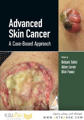 Advanced Skin Cancer: A Case-Based Approach
