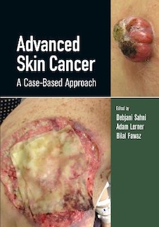 عکس Advanced Skin Cancer: A Case-Based Approach