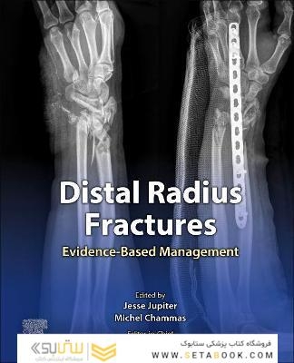 Distal Radius Fractures : Evidence-Based Management
