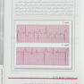 تفسیر ساده و روان الکتروکاردیوگرام ECG