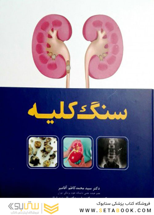 سنگ کلیه