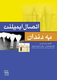 عکس اتصال ایمپلنت به دندان