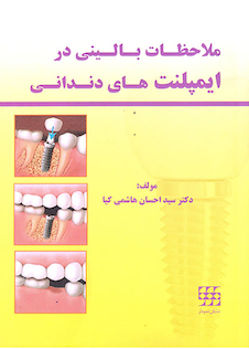 عکس ملاحظات بالینی در ایمپلنت های دندانی