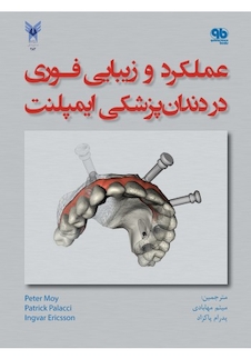 عکس عملکرد و زیبایی فوری در دندانپزشکی ایمپلنت