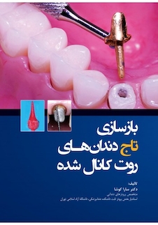 عکس بازسازی تاج دندان های روت کانال شده