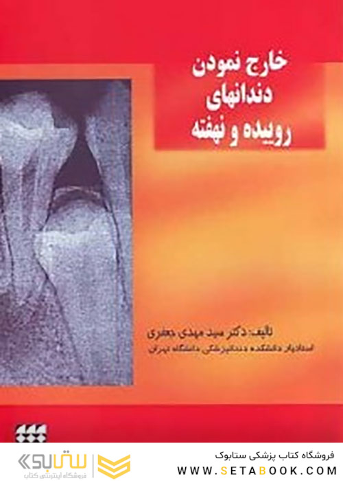 خارج نمودن دندانهای روییده و نهفته