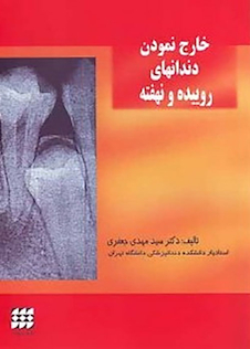 عکس خارج نمودن دندانهای روییده و نهفته