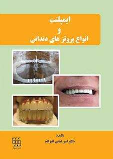 عکس ایمپلنت و انواع پروتزهای دندانی