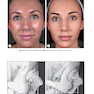 Soft Tissue Augmentation: Procedures in Cosmetic Dermatology Series