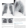 Muller’s Imaging of the Chest, 2nd Edition2018