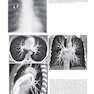 Muller’s Imaging of the Chest, 2nd Edition2018